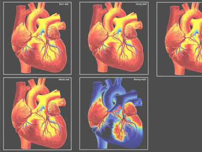 mmi-mycardial-pi-merivale-medical-imaging.webp